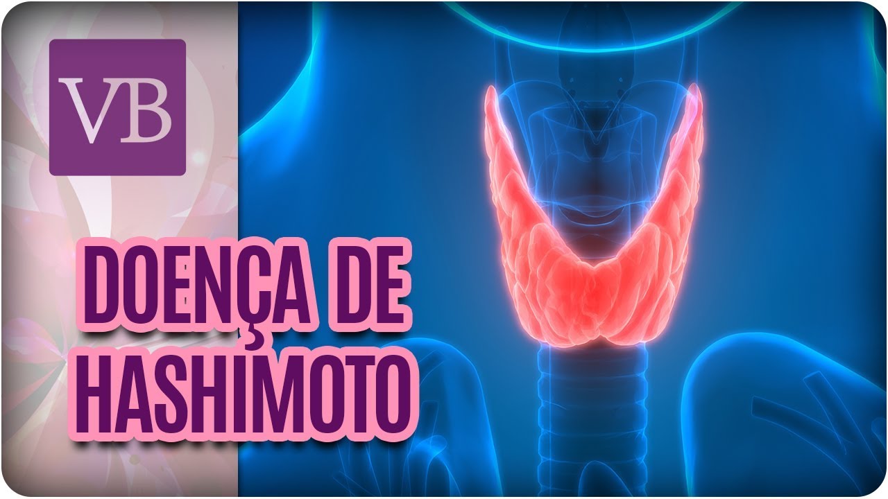 Doença de Hashimoto: Como Diagnosticar e Tratar - Você Bonita (29/03/18) tireoide engorda