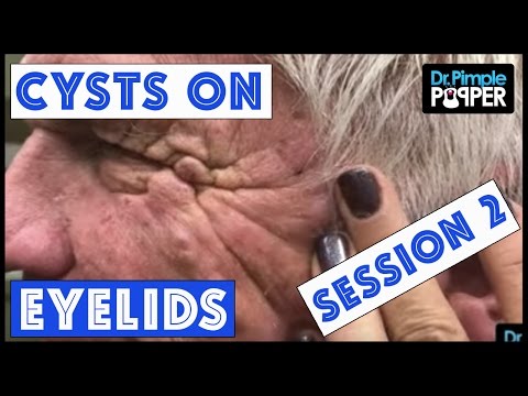 Cysts That Weigh Very HEAVY On The EYELIDS Session 2