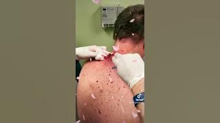 Dr. Greenberg Cyst Follow up video 🎥 with Las Vegas Dermatology® incision & drainage procedure 💉 🔪