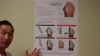 Lapiplasty is the Best Bunion Treatment Option!