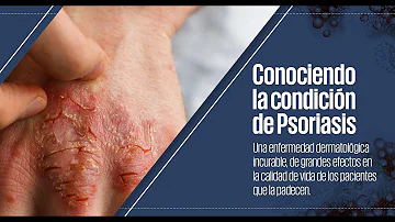 ¿En quién es más común la psoriasis?