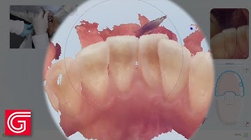 How To Accurately Scan Lower Anterior Teeth