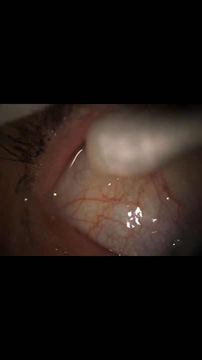 Something’s in her eye… the dangers of contact lenses