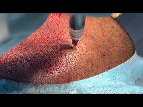 Hair Transplantation Surgical video FUE Scarless technique in India - Part 1