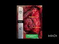 @drprriya  Mediastinal Sarcoma-Hemiclamshell approach
