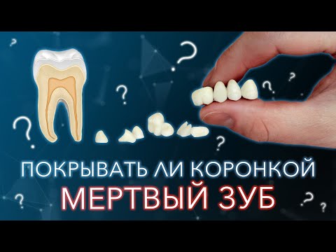 Мертвый зуб без нерва. Покрывать ли его коронкой.