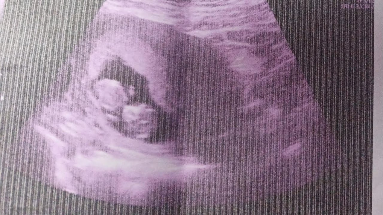 3 علامات في المنطقة الحساسة تأكد وجود حمل قبل ميعاد الدورة ب4 أيام 