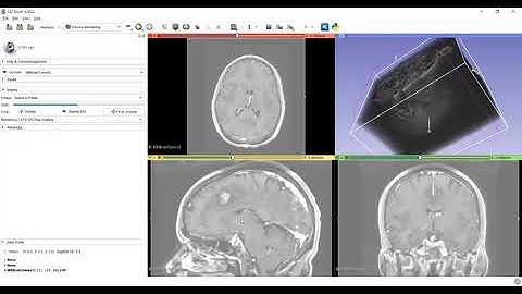 Volume rendering and ROI on brain tumour using 3D Slicer