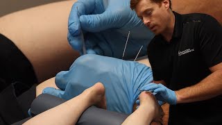 Gold Standard Treatment for Plantar Fasciitis │ Dry Needling, Shockwave, & Chiropractic Adjustment