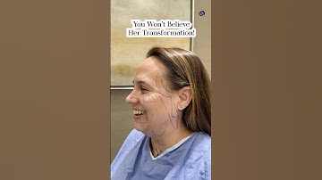 Natural Results| Face Lift 2 Months Post-Op| Before and After