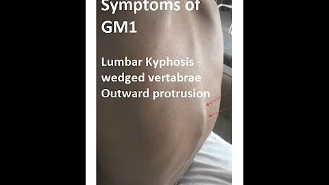 What is GM1? Rare Disease Day? Symptoms of GM1? Living with GM1?