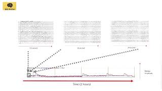 Quantitative EEG: Envelope Trend