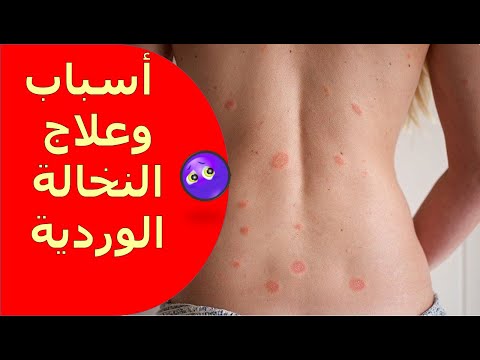 مرض النخالة الوردية 😣 الأسباب والاعراض 📝 وروشتة العلاج 🤔👌