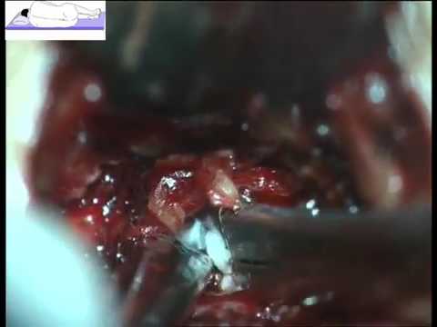 Секвестрированная грыжа диска