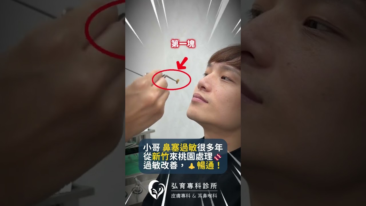 鼻子通了很舒服。It feels so good to have a clear nose. #鼻塞 #鼻過敏 #微創手術 #弘育耳鼻喉科診所 #桃園市藝文特區 縮圖
