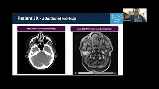 AHNS Virtual Tumor Board: Multi-Disciplinary Management of Salivary Cancer