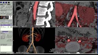 احتراف معالجة صور الشرايين الكلوية 3D | CT Renal Angio Post-Processing