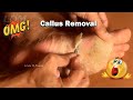 Callus Removal From Feet - 足からのカルス除去＃48