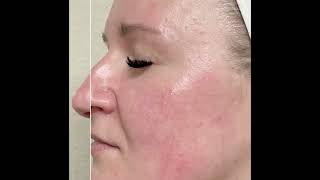 CACI Synergy Flex, Micro-Pro and Rejuva Med
