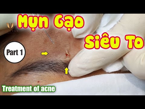 Cách điều trị mụn gạo - mụn bà lão hiệu quả.Tại Hiền Vân Spa - bài 180