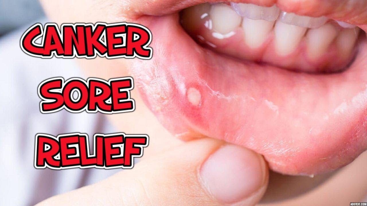 How To Get Rid Of A Canker Sore YouTube
