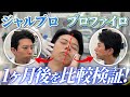 今注目の肌育注射“ジャルプロスーパーハイドロ” vs 小じわ改善の王道“プロファイロ”を半顔ずつ効果を比較しました！【アンチエイジング】