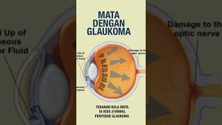 Penyebab Terjadinya Glaukoma - dr.Danti Ayu Irawati,SpM