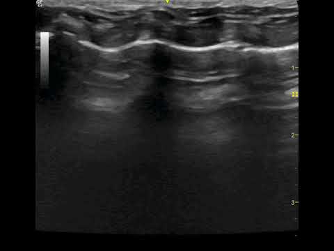 Lung ultrasound: pneumonia in a cat 