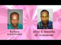 Hair loss treatment for men     hair loss  treatment   