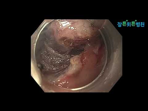 Gastric GIST removed through Gastric ESD 2021 07 16