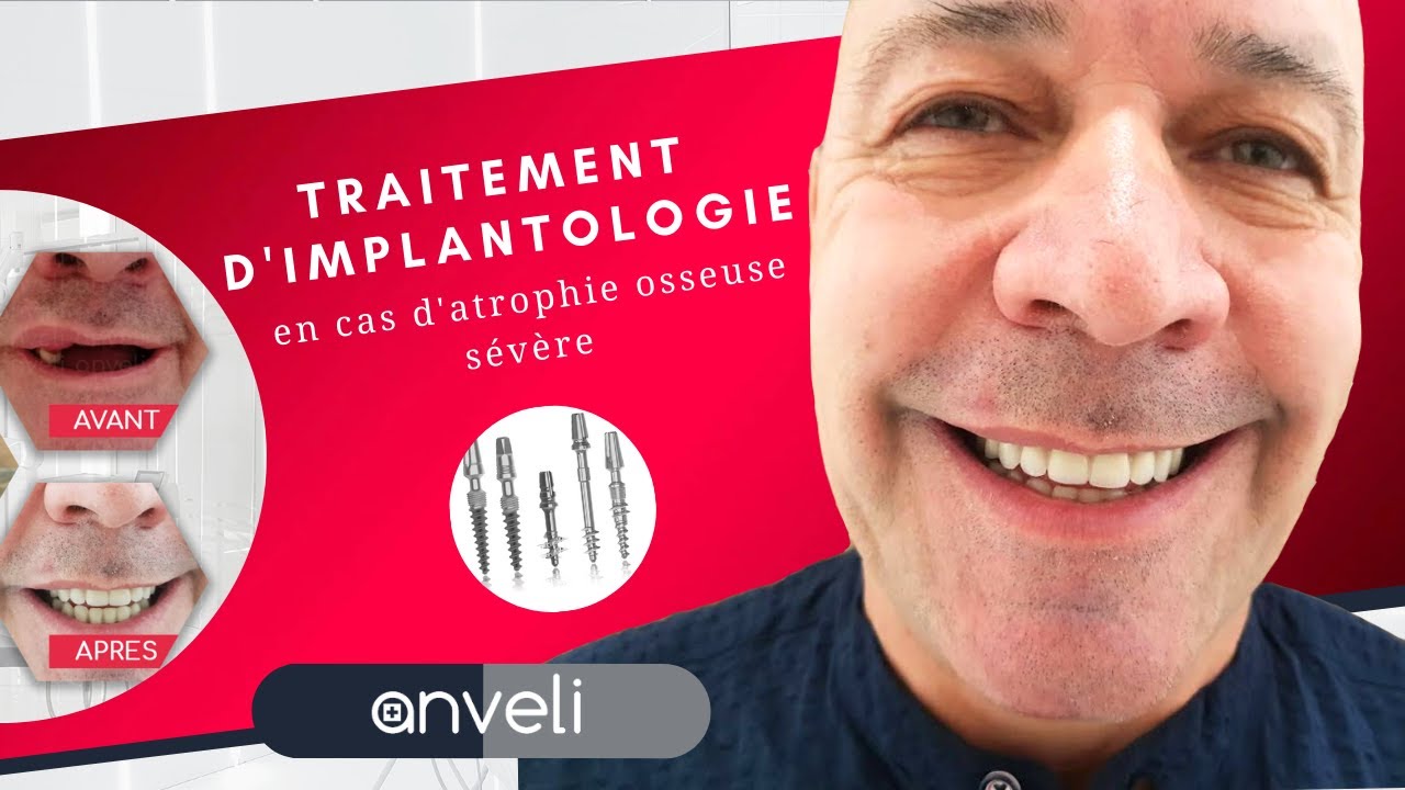 Traitement d'implantologie en cas d'atrophie osseuse sévère