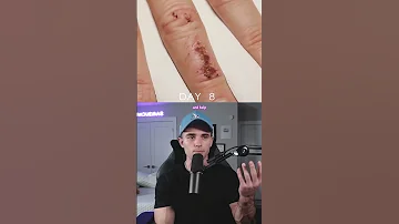 How A Wound Heals 