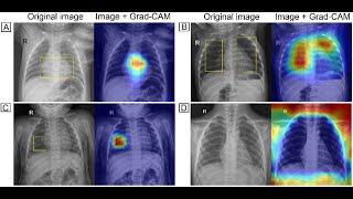 X-Ray With Grad-Cam Ai Method