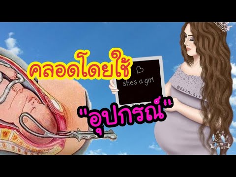 คลอดธรรมชาติโดยใช้อุปกรณ์ช่วย | คลอดโดยใช้คีบหรือเครื่องดูด