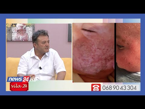 Video: Dermatiti Atopik Tek Fëmijët: Shkaqet, Simptomat, Trajtimi