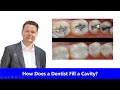 How Does a Dentist Fill a Cavity?