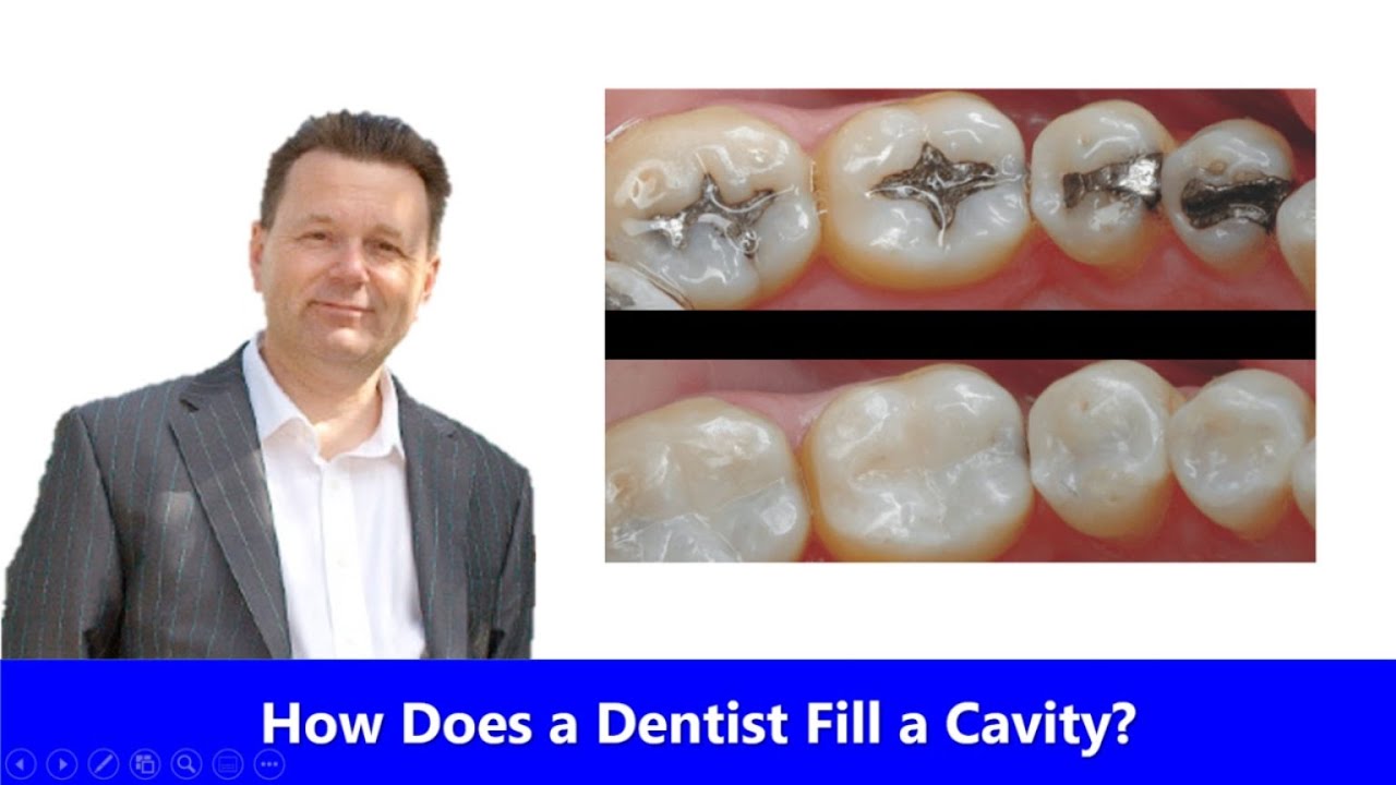 How Long Does a Cavity Filling Take