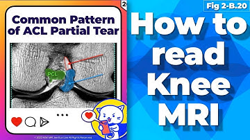 한글 (Fig 2-B.20) Common pattern of the ACL Partial Tear