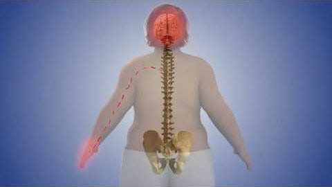 Spinal Cord Stimulator Implant & CRPS Animation Procedure