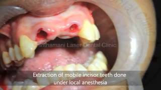 Thumbnail of Large gap between upper front teeth treated with BCS Implants  YouTube