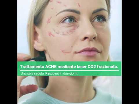 acne trattamento