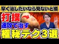 【速攻治す】打撲の痛み腫れを最速で改善させるセルフケア３選【打撲・打ち身】