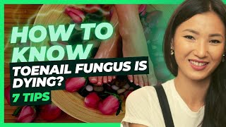 Signs of a Dying Toenail Fungus: How to Recognize the Healing Process [7 great tips]