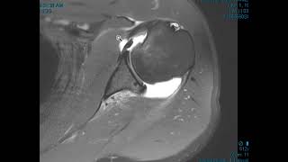 Posterior Shoulder Dislocation With Reverse Hill Sachs Deformity