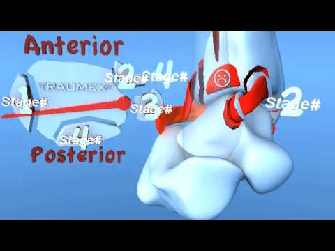 Lauge Hansen PER Pronation External Rotation (Ever...