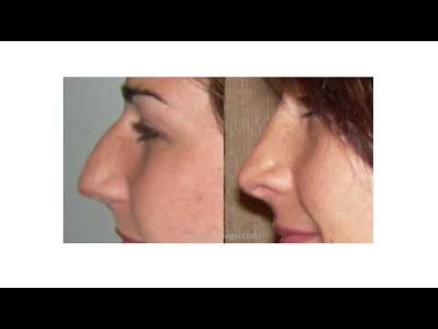 Video thumbnail: Rhinoplasty · The Spiegel Center