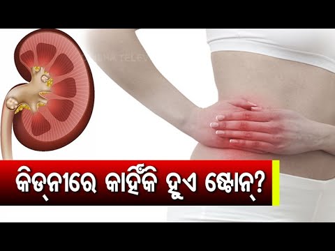 Kidney Stone- Cause, Diagnosis & Treatment