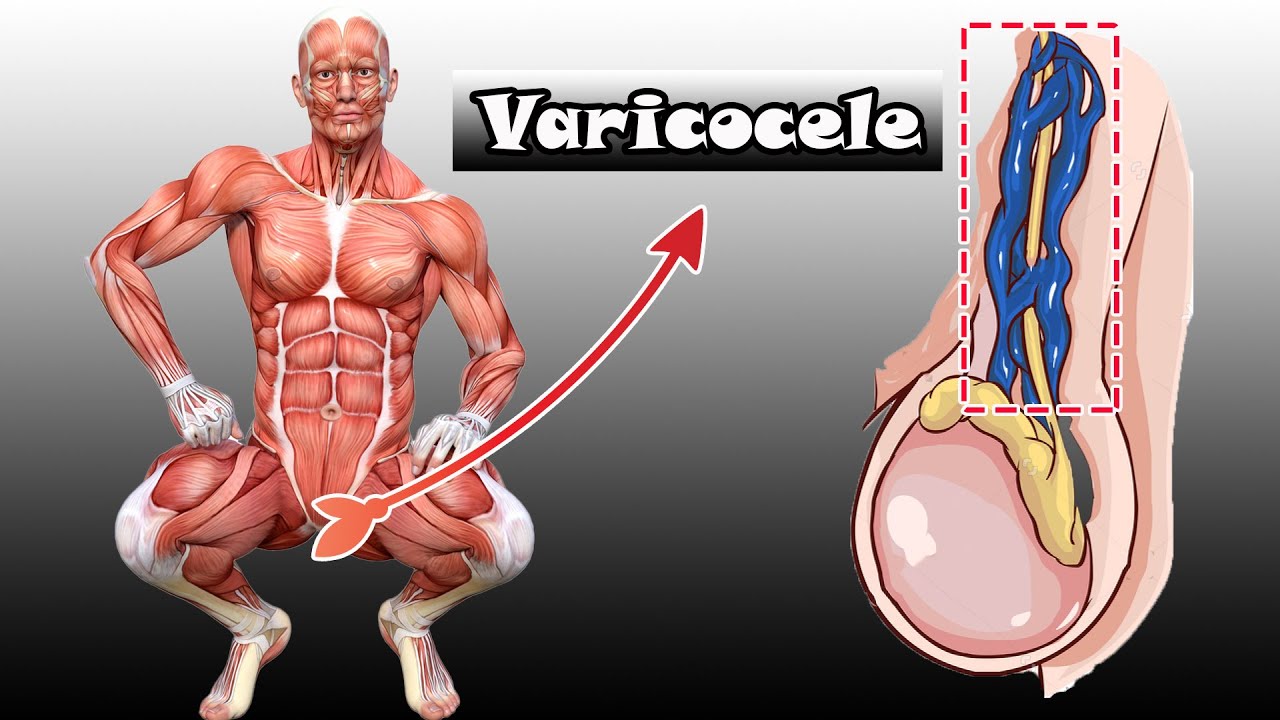 Exercises To Treat Varicocele for Men 