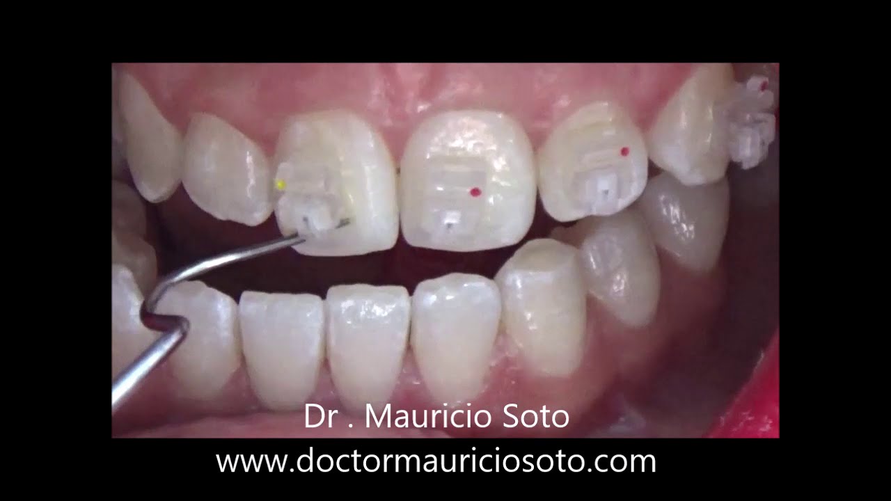 Orthodontic Brackets Bonding step by step YouTube