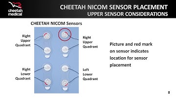 CHEETAH NICOM™ Sensor Placement